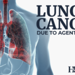 lung cancer agent orange