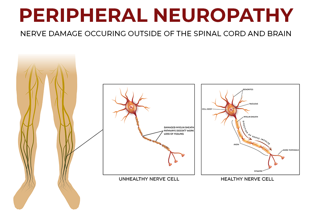 peripheral neuropahy