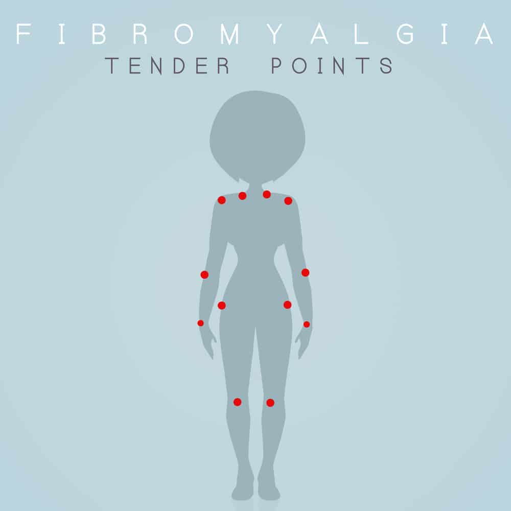 Depiction of fibromyalgia tender points. fibromyalgia va rating