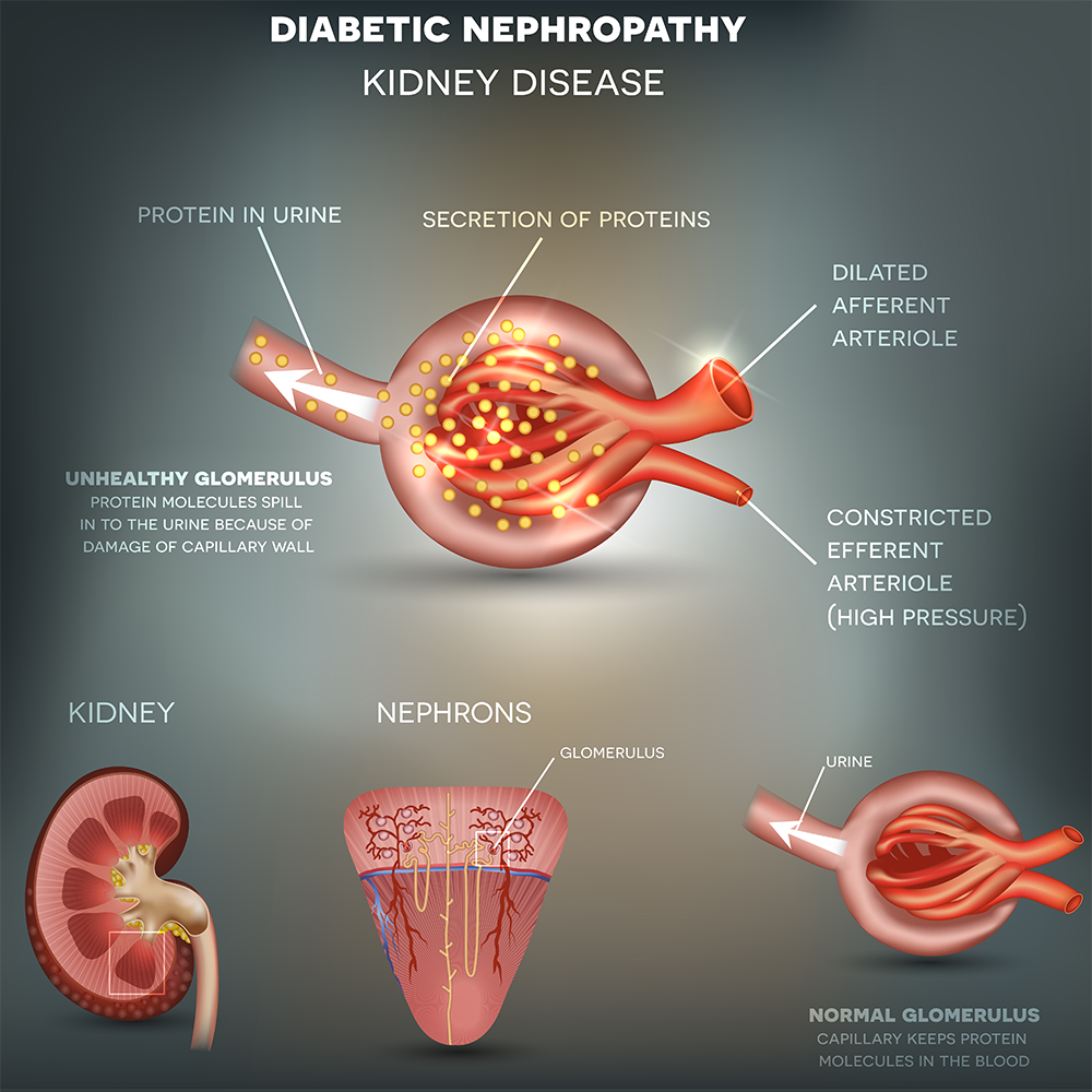 diabetic nephropathy kidney disease