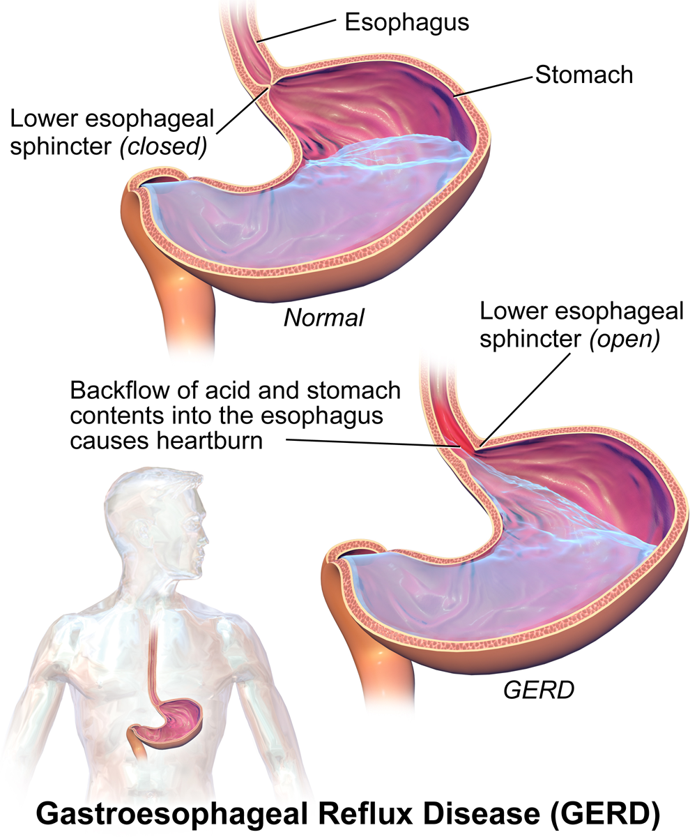 Acid reflux caused by pregnancy