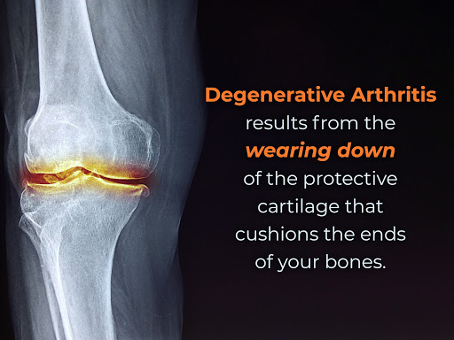 Description of degenerative arthritis. VA arthritis rating