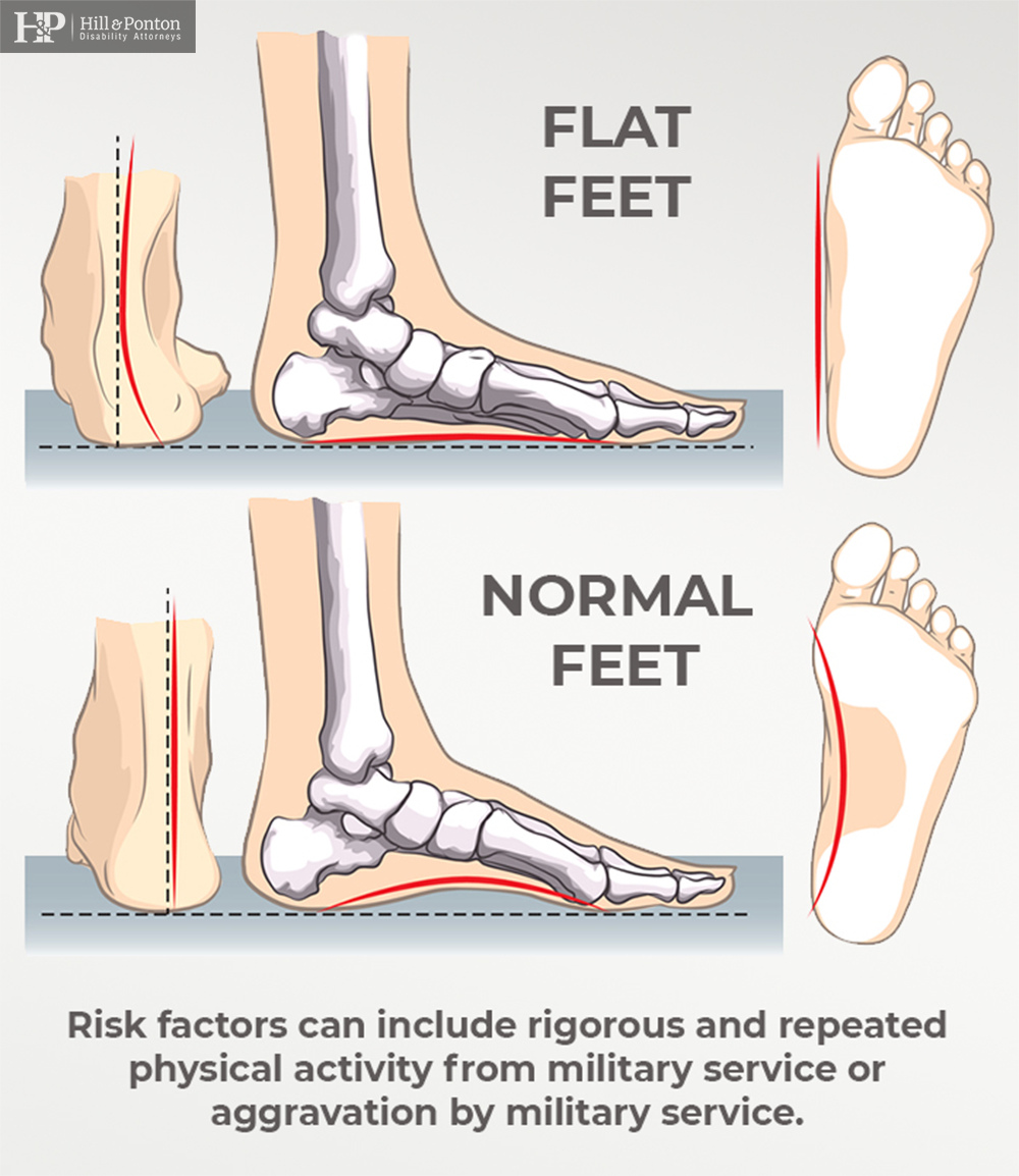 VA Disability Ratings for Flat Feet - Hill & Ponton, P.A.