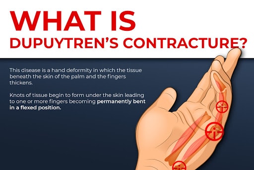 what is dupuytren contracture?