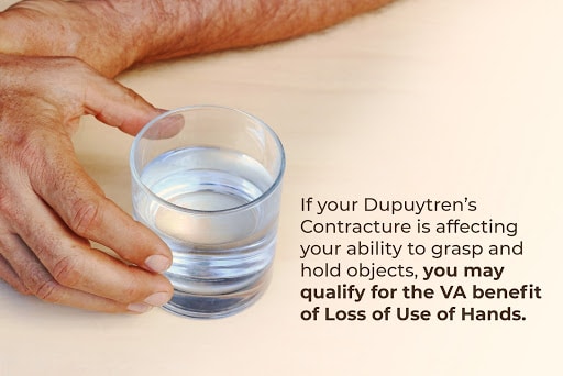 dupuytren contracture loss of use