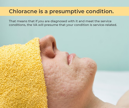 is chloracne a presumptive condition?