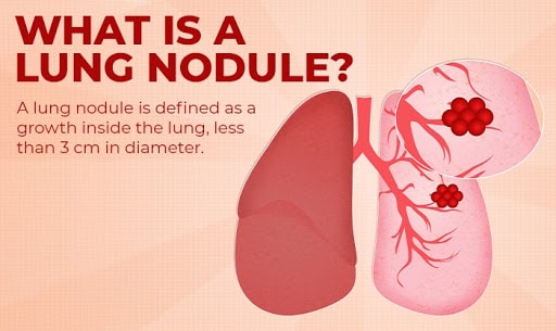 va disability for lung nodule