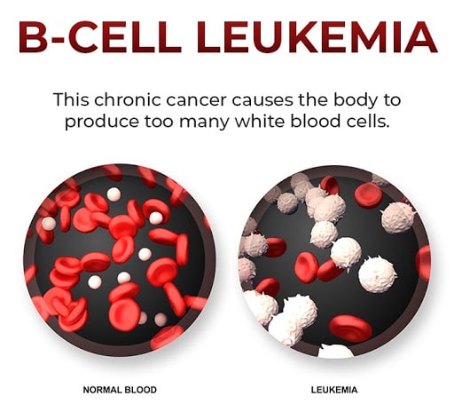 chronic b-cell leukemia and agent orange