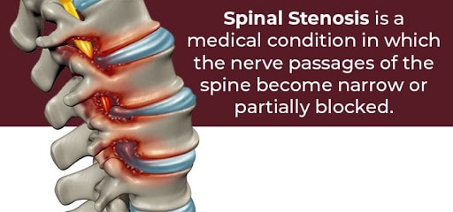 spinal stenosis va disability rating