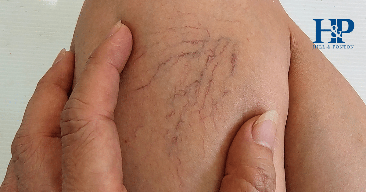 Varicose Veins VA Rating