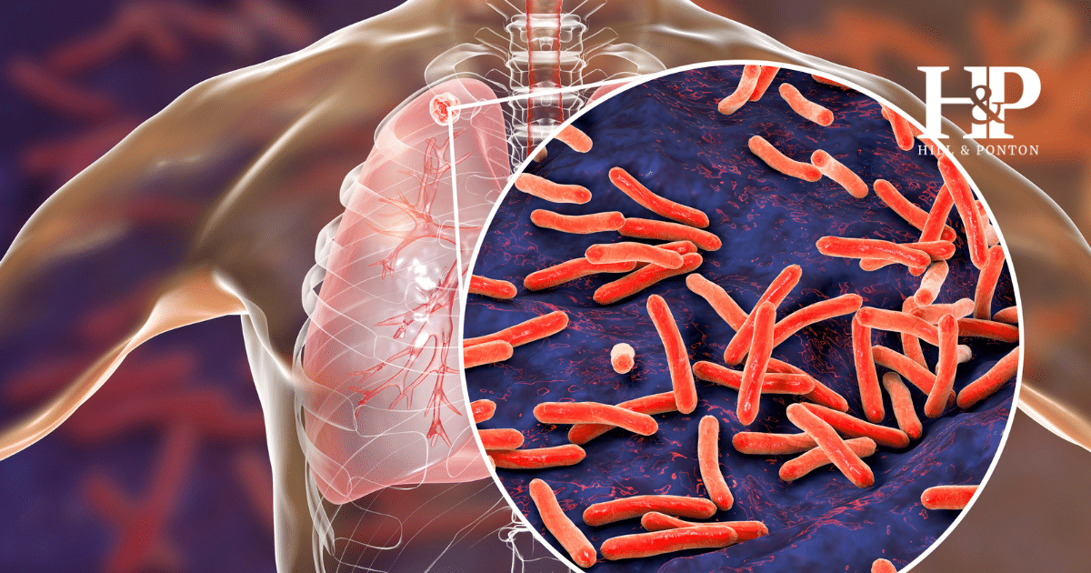 Tuberculosis VA Rating