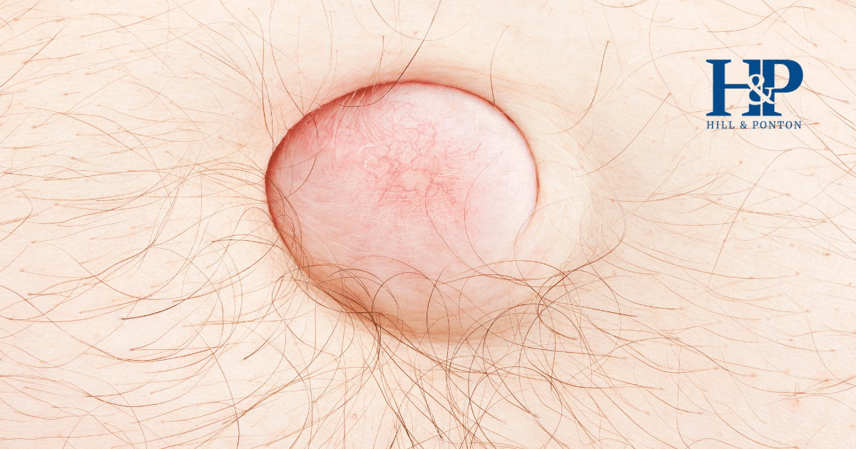 Hiatal Hernia VA Rating