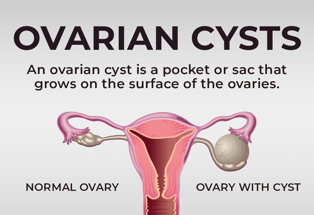 ovarian cysts
