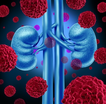 Kidney Cancer