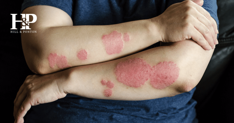 Skin Conditions VA Rating