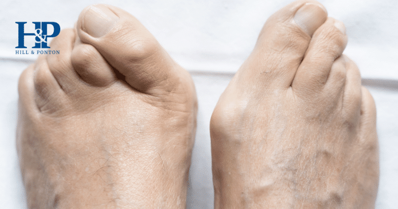 Bunions VA Rating