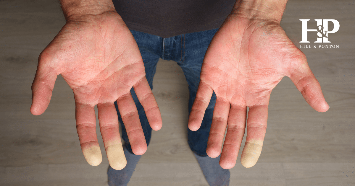 Raynauds Syndrome VA Rating