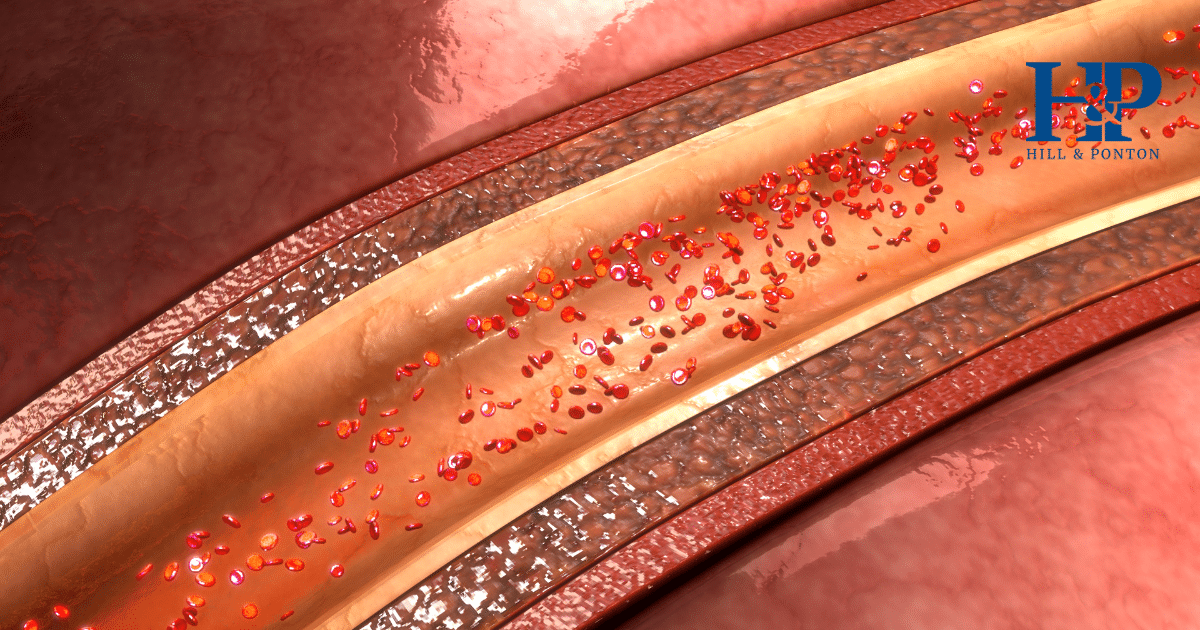 Arteriosclerosis VA Rating