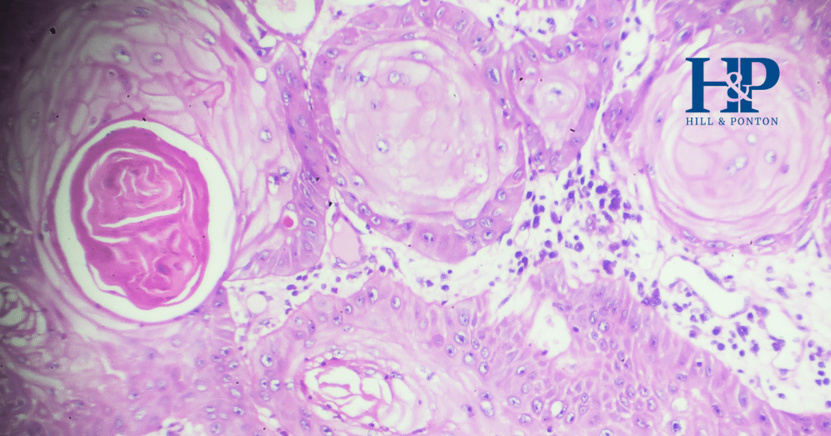 VA Disability for Squamous Cell Carcinoma