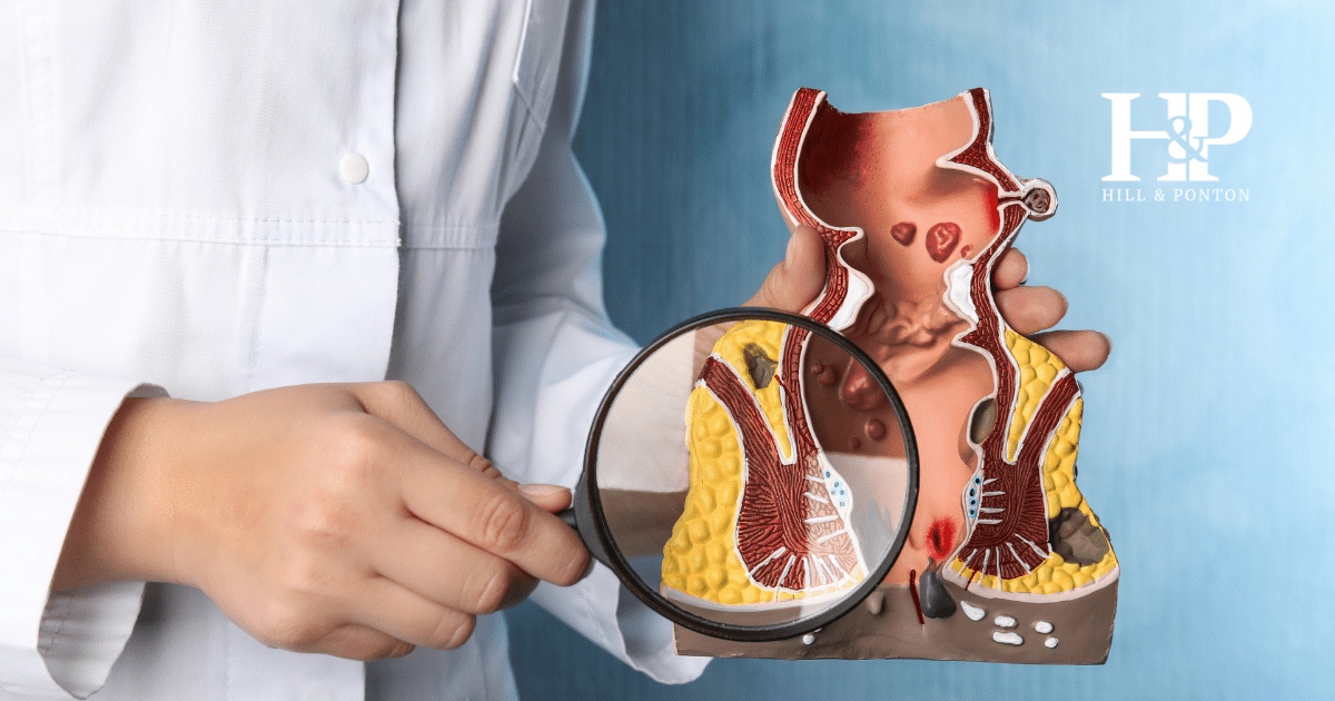 Getting a VA Rating for Hemorrhoids