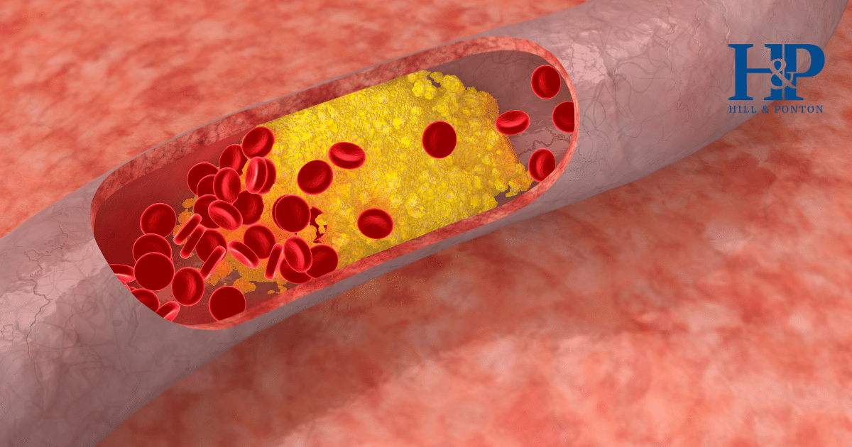 High Cholesterol VA Rating