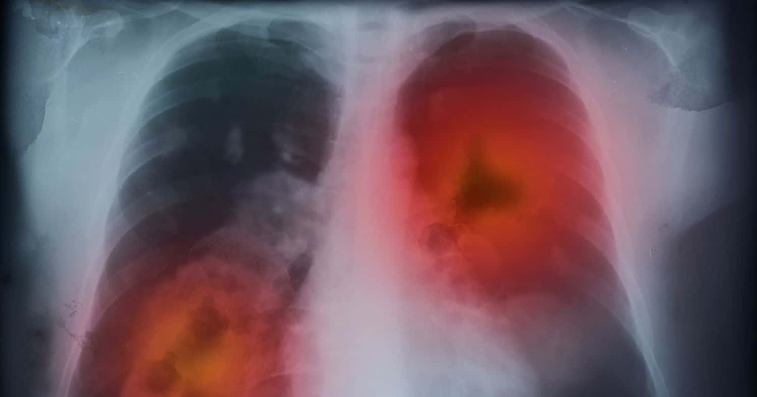 lungs with granulomatous disease
