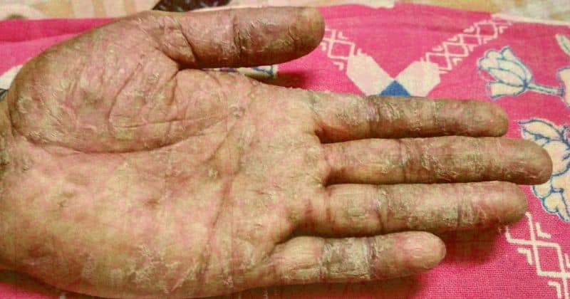 Porphyria Cutanea Tarda Agent Orange